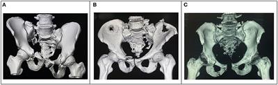 Spinopelvic Fixation Supplemented With Gullwing Plate for Multiplanar Sacral Fracture With Spinopelvic Dissociation: A Case Series With Short Term Follow Up